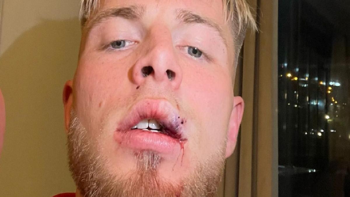 Samsunspor’da Rick van Drongelen’in dudağına dikiş atıldı