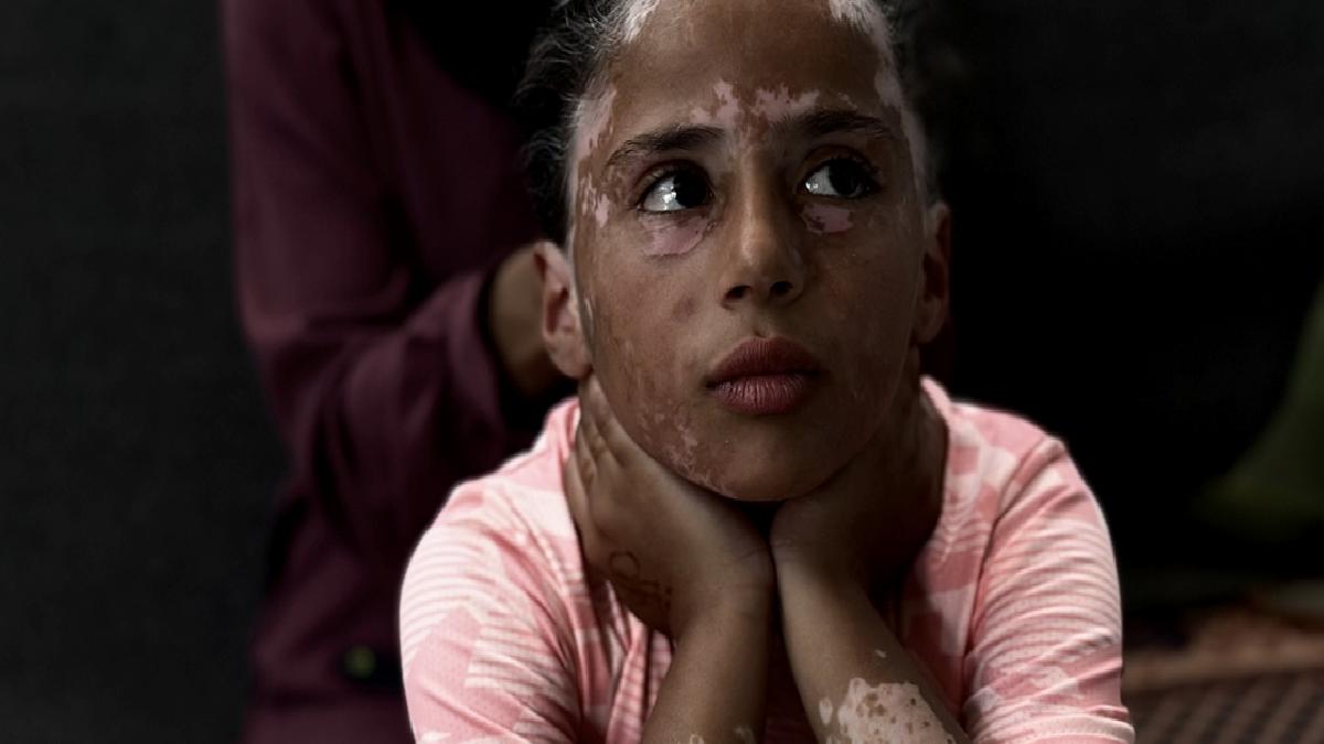 Gazzeli Lana, İsrail korkusu yüzünden vitiligo hastalığına yakalandı